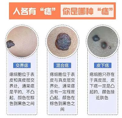半岛·综合体育入口医院点痣多少钱一颗？便美便好问答(图2)